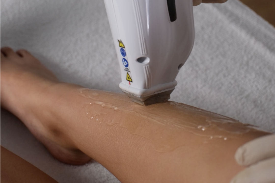 Epilazione laser gambe Eden Center