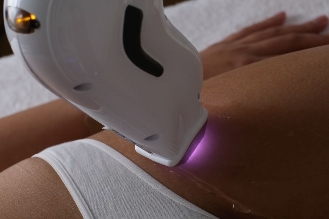 Epilazione laser inguine Eden Center